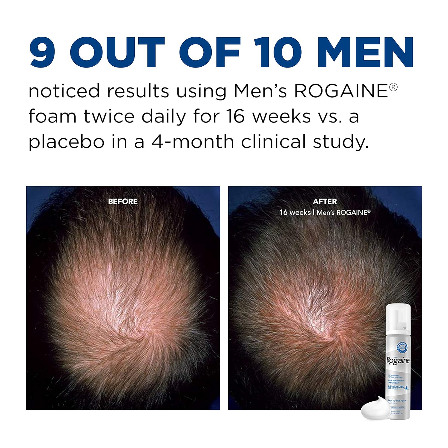 Men's Rogaine Foam Hair deals regrowth